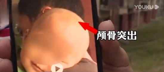 湖南郴州再现“大头娃娃”是怎么回事大头娃娃怎么形成的