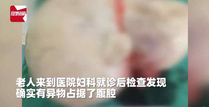 七旬老妇肚子突然隆起还越长越大 去医院检查后医生直呼罕见