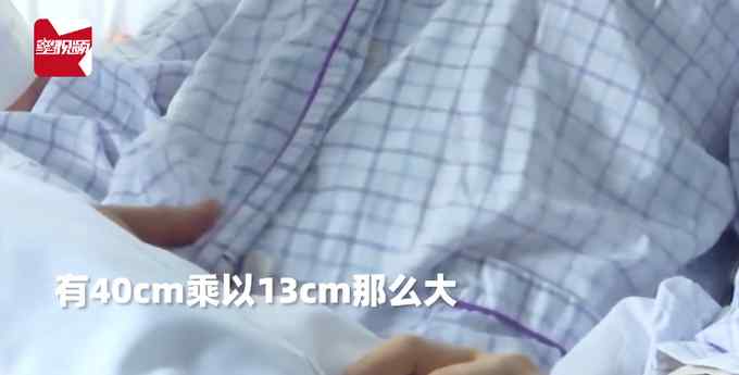 七旬老妇肚子突然隆起还越长越大 去医院检查后医生直呼罕见