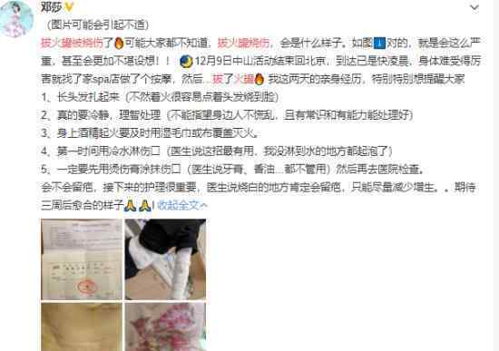 邓莎拔火罐被烧伤怎么回事邓莎烧伤严重吗