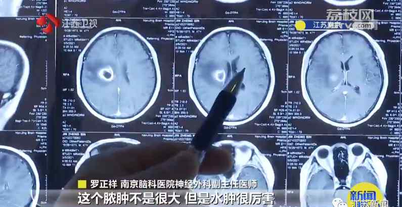 46岁男子挤痘痘致上肢瘫痪！“危险三角区”千万被乱碰