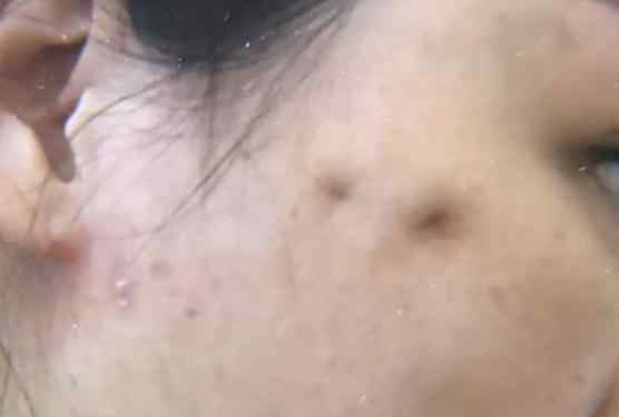 怎么修复脸上的凹坑 女子花1万6做线雕，术后脸上出现5个凹坑，朋友：看着像被刀捅过