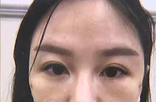 怎么修复脸上的凹坑 女子花1万6做线雕，术后脸上出现5个凹坑，朋友：看着像被刀捅过