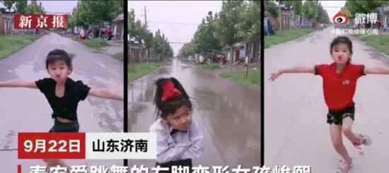 爱跳舞左脚畸形女孩接受公益救治 已接受手术 术后情况如何