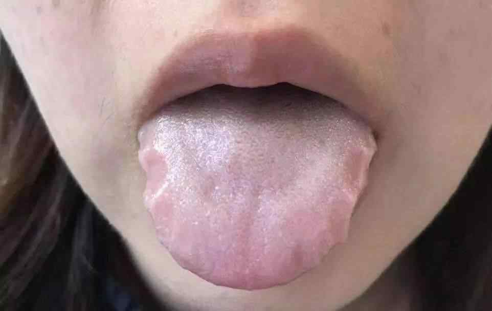 齿痕舌 舌头有齿痕代表湿气重？90%的人都吃错红豆薏米了！
