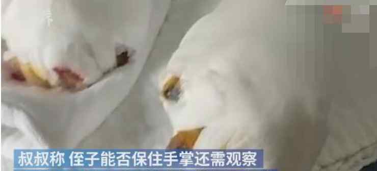 疑遭生父烫伤男童切除部分手指 到底是什么状况？