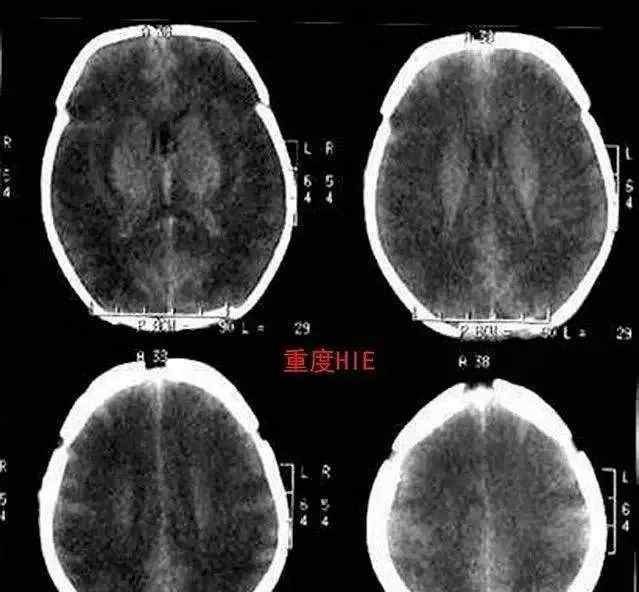 新生儿脑缺氧的症状 【认识早产儿疾病】系列科普：新生儿缺氧缺血性脑病