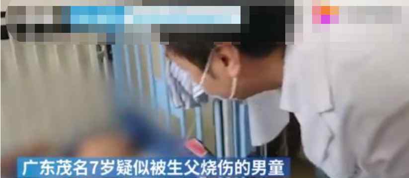 疑遭生父烫伤男童切除部分手指 到底是什么状况？