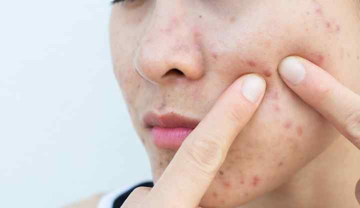 女孩挤痘引发颅内感染 究竟是怎么一回事?