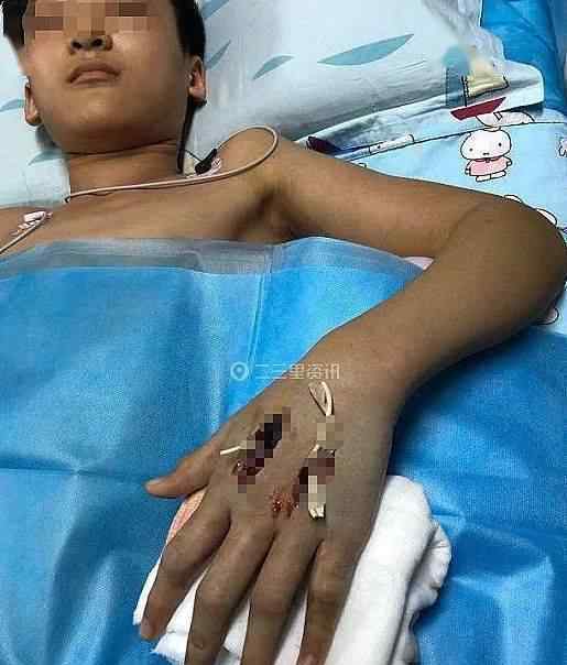 13岁男孩网购宠物蛇被咬进ICU 事件详情始末介绍！