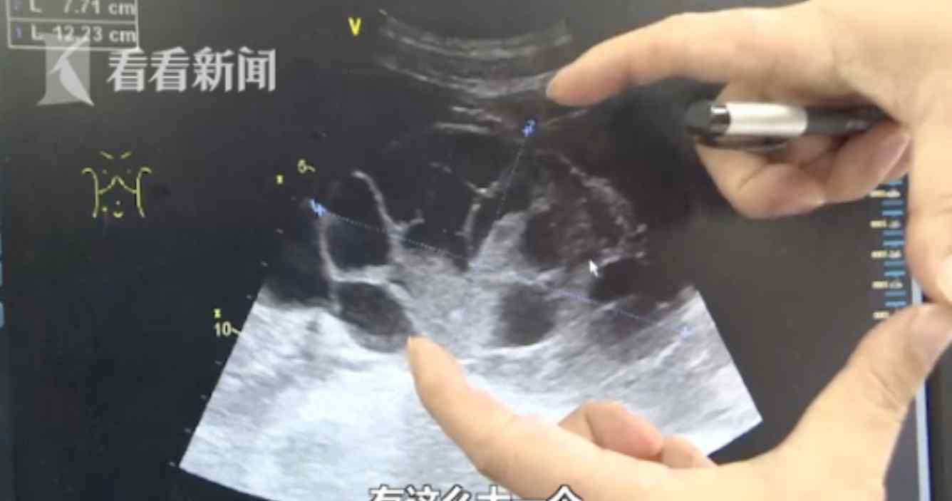 肚里抽出十几斤水 卖卵原因竟是为了一台手机