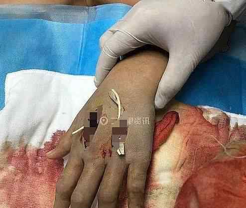 13岁男孩网购宠物蛇被咬进ICU 事件详情始末介绍！