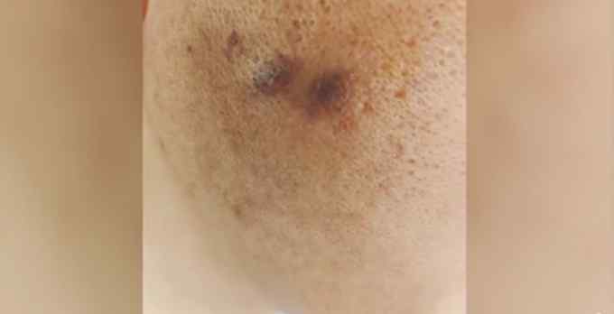 男子遭高管烟头烫脸 还称让他“长记性”！公司：当事高管已被免职