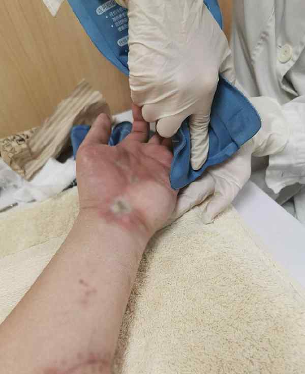陶勇称左手很难恢复 到底是什么状况？