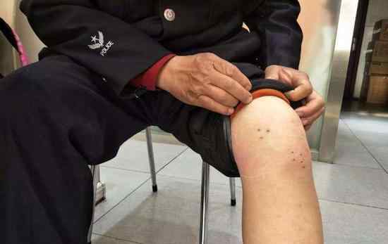 蚂蝗钻左腿存活3年 医生看到虫子表示吃惊