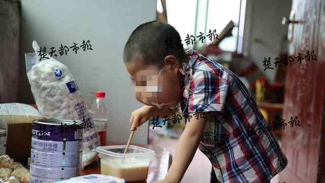 5岁男孩脸似河马 无法呼吸不能用口吃饭