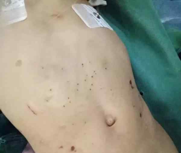 3岁女童遭后妈虐死 下体会阴部腐烂流脓