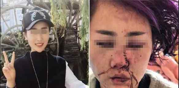 毁容女孩公开近照 6名嫌疑人被提起公诉