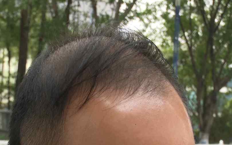 男子理发耳朵被剪掉一块肉 理发店竟拒绝索赔要求：不介意“以肉换肉”