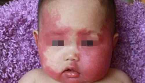 咖啡斑痣 婴幼儿各种胎记和斑痣解析大全，建议家长收藏！