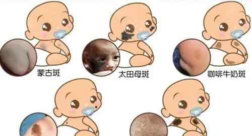 咖啡斑痣 婴幼儿各种胎记和斑痣解析大全，建议家长收藏！