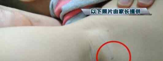 幼儿身上现针眼案:3涉案教师被捕 曝光事件经过详情始末