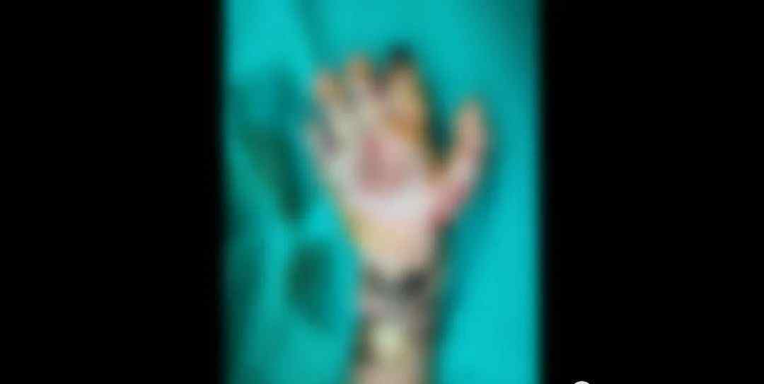 男童遭亲父烟头烫伤双手面临截肢，家里还有2个弟弟妹妹