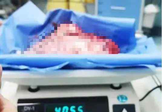 女子腹大如怀胎8月 医生取出一8斤重的“怪东西”
