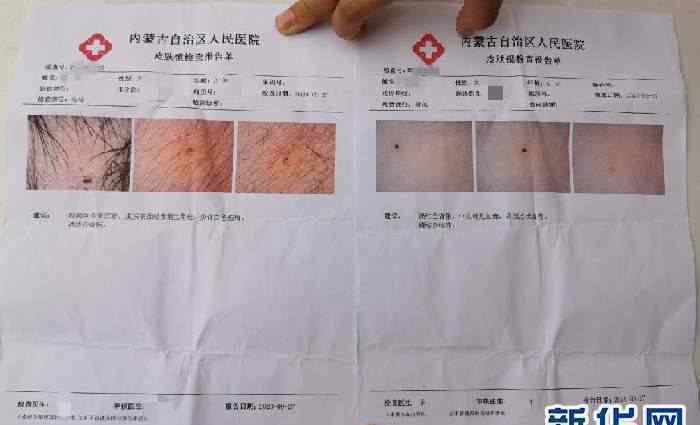 幼儿身上现针眼案:3涉案教师被捕 孩子不听话就用针扎太狠心