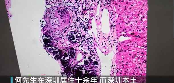 男子去体检肝部遍布密密麻麻阴影 医生追问发现可怕真相