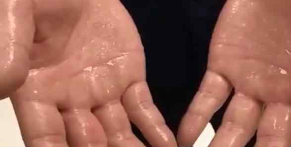 女孩手掌心常年“流汗如雨” 医生检查结果令人意想不到