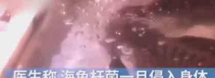 广东深圳一市民手上出现“大窟窿”急忙就诊 医生一看当场惊了