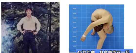 身体被敲断4次的折叠人出院 “折叠人”病因从何而来