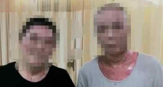夫妻被烧伤丈夫称先救妻子 具体事情经过如何