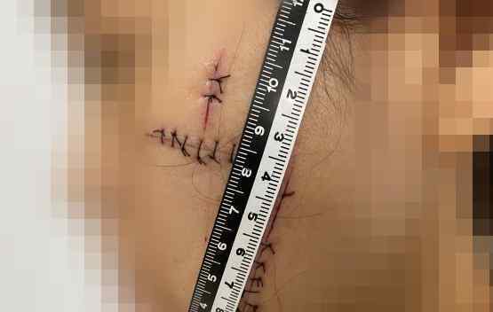 杭州一男子开车带前女友到墓地 一刀一刀地划她的脸