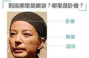 吸脂除掉眼袋 年轻人有眼袋？可通过激光或内切去除 | 名医专访