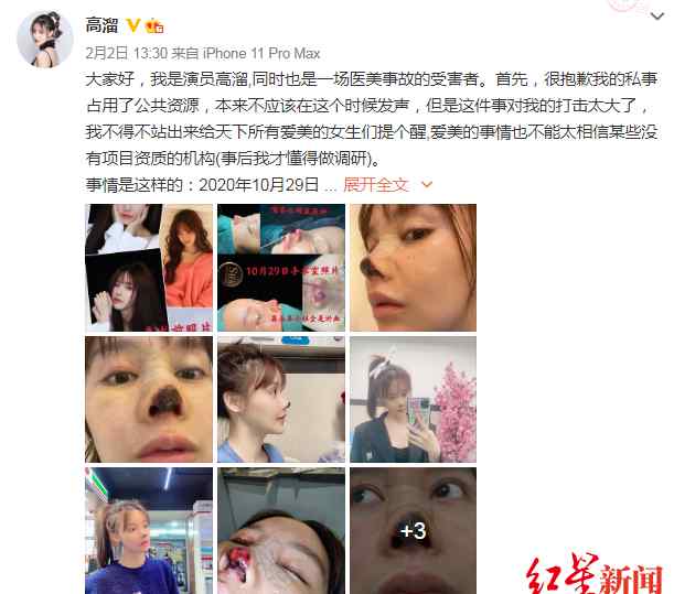 官方通报高溜整形失败鼻尖坏死：医生被暂停执业半年