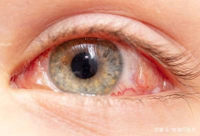 眼睛玻璃体混浊怎么治疗 眼睛玻璃体混浊能治好吗，它的病因有哪些