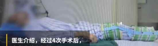 身体折叠28年终于挺直脊梁 折叠人到底是什么病
