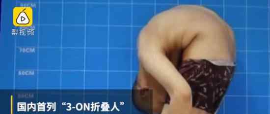 身体折叠28年终于挺直脊梁 折叠人到底是什么病