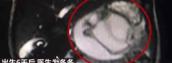 男婴腹中藏寄生胎 是怎么回事还能活下来吗