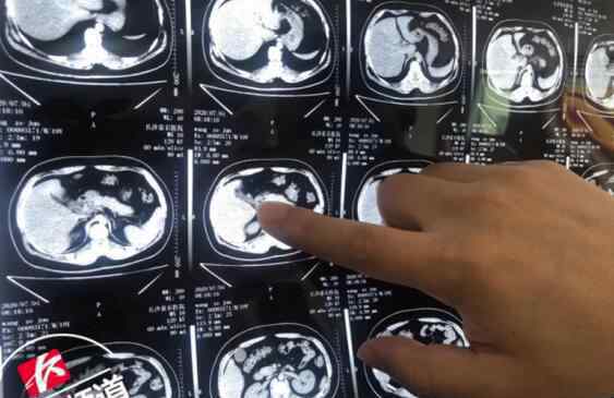 男子腹部剧痛入院以为是胃病 究竟发生了什么