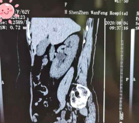 六旬阿姨夜间突发结石绞痛 究竟发生了什么