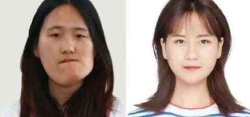 歪脸女孩手术成功说要回山里当老师 究竟发生了什么