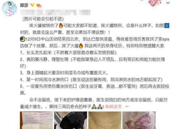 邓莎拔火罐被烧伤 是怎么回事邓莎个人资料介绍