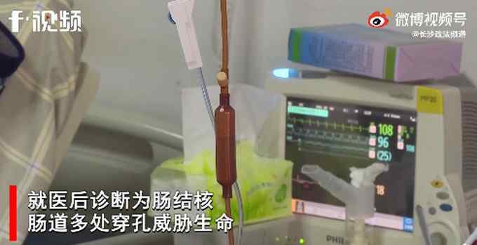 IT男长期加班肠穿孔险丧命 医生紧急提醒！网友直呼：代入感好强