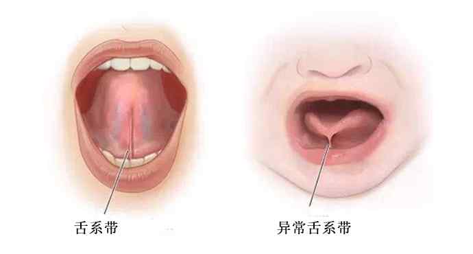 短怎么读 舌头短怎么影响说话？