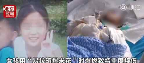 女孩模仿短视频被重度烧伤 模仿什么短视频女孩现在怎么样了?