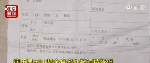 女孩模仿短视频被重度烧伤 模仿什么短视频女孩现在怎么样了?