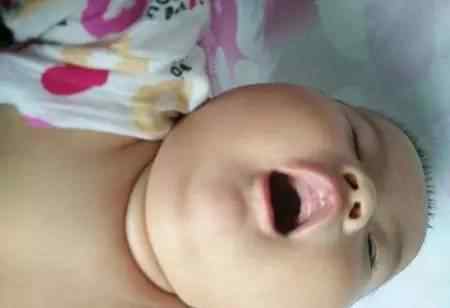 婴儿鹅口疮怎么治疗 宝宝鹅口疮到底是什么？如何预防和治疗